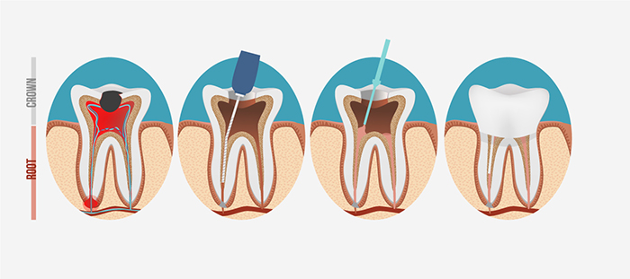 根管治療は、治療した歯の予後(生存率)を左右する非常に重要な治療です。