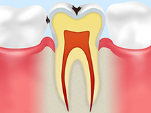 エナメル質のむし歯（C1）