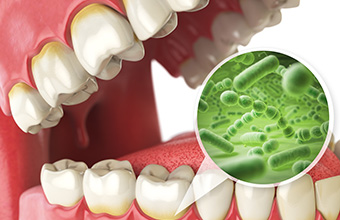 歯周病の原因はプラーク内の細菌